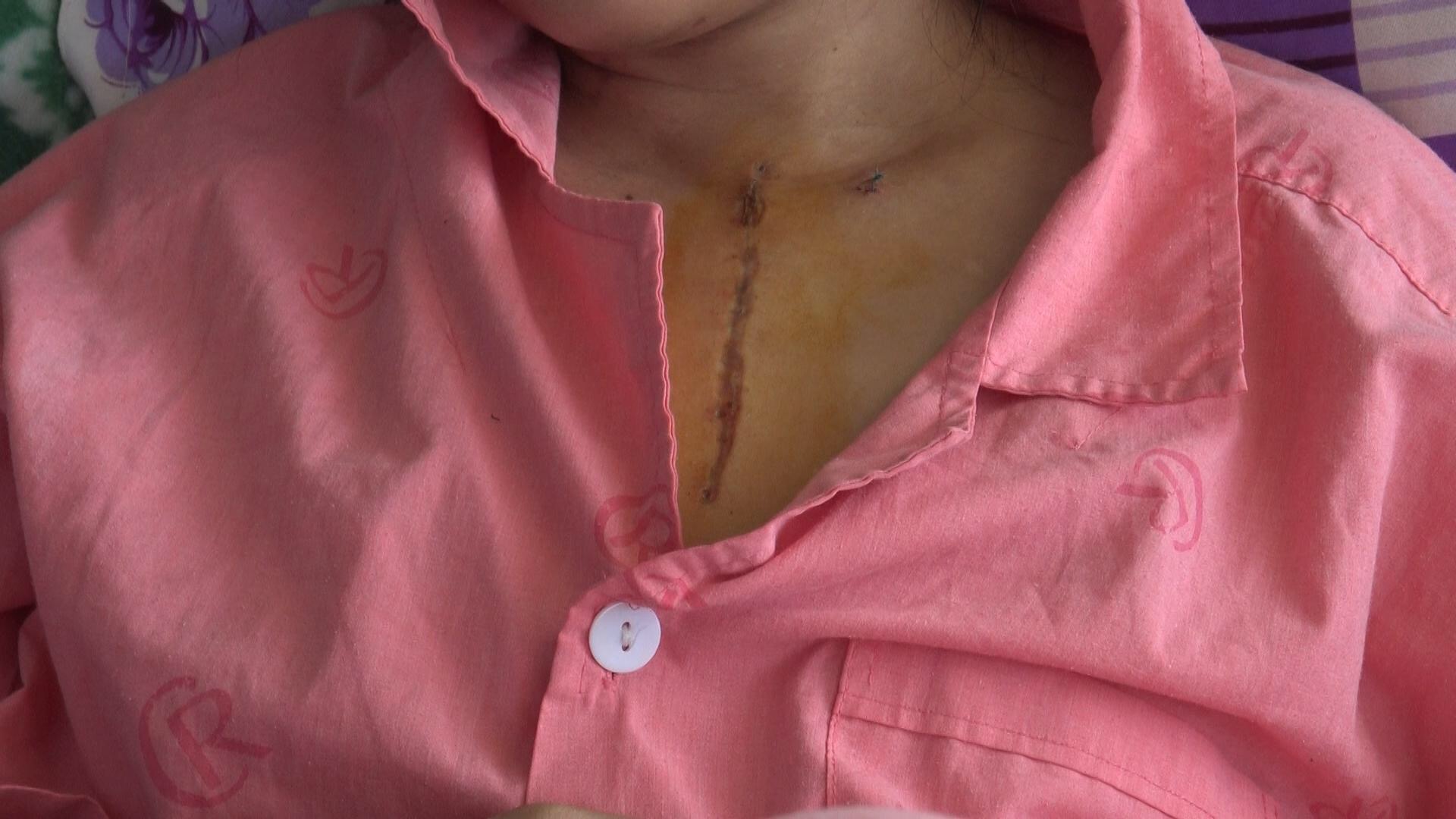 Bệnh nhân Thi Thị D. với vết mổ sau ca phẫu thuật hiếm của Việt Nam và thế giới