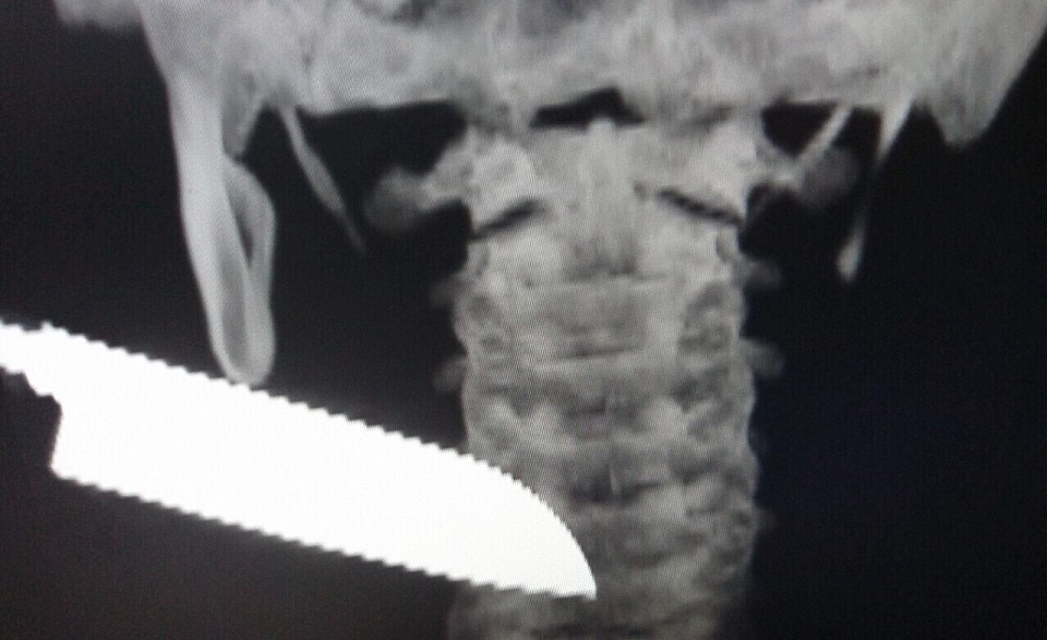 Hình ảnh bệnh nhân nhập viện với lưỡi dao 13 cm đâm lút cán phần cổ - Ảnh: Bác sĩ cung cấp