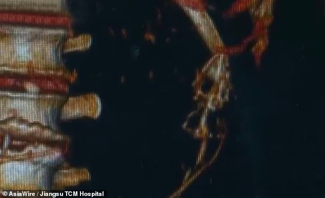 Hình ảnh X-quang cho thấy hai con lươn nằm ở hai bên bụng bệnh nhân.