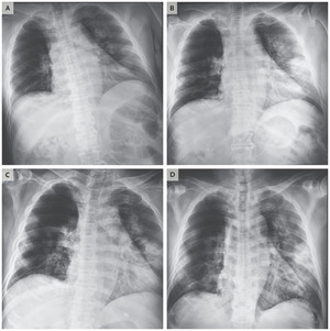 Hình ảnh X-quang phổi của một bệnh nhân viêm phổi cấp. Ảnh: Nejm