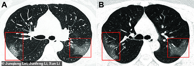 Phổi ảnh của một bệnh nhân nhiễm 2019-nCoV tại Trung Quốc. Phần đốm trắng thể hiện chất lỏng tích tụ trong phổi.