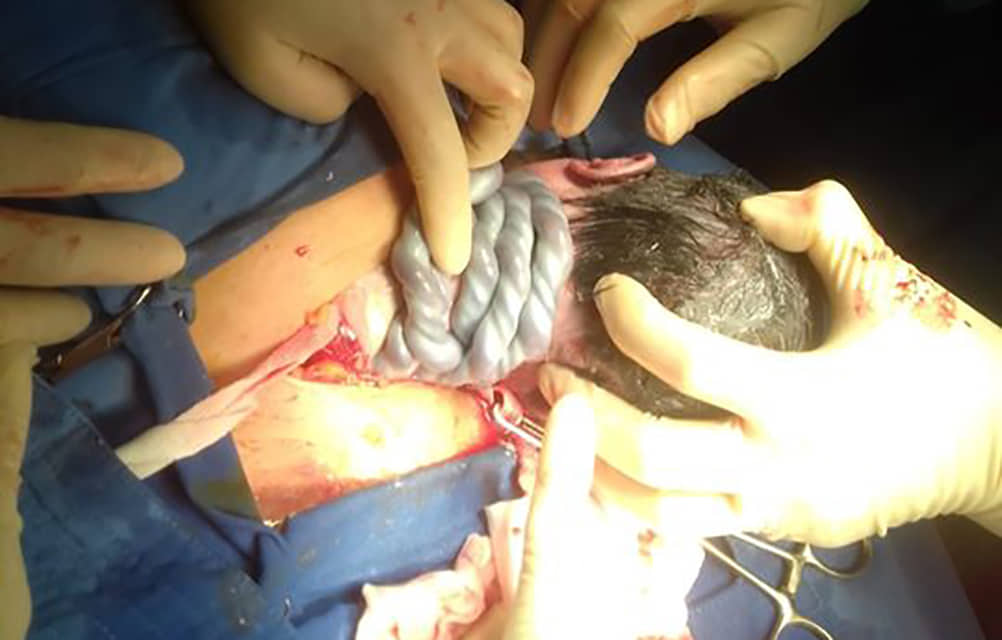 Cháu bé sơ sinh bị dây rốn quấn 4 vòng cổ đã chào đời an toàn