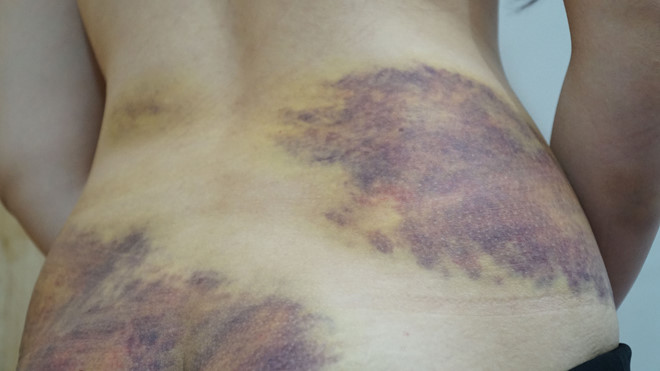 Những vết bầm trên thân thể chị S ở Tây Ninh