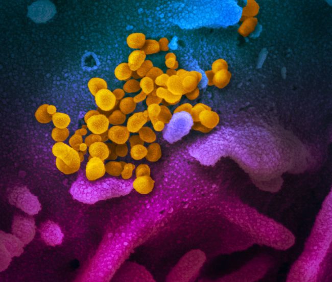 Hình ảnh kính hiển vi điện tử quét này cho thấy coronavirus mới (màu vàng) giữa các tế bào người (xanh, hồng và tím). (Màu sắc đã được thêm vào hình ảnh để hiển thị tốt hơn về vi-rút và môi trường của nó.) (Tín dụng hình ảnh: NIAID-RML)