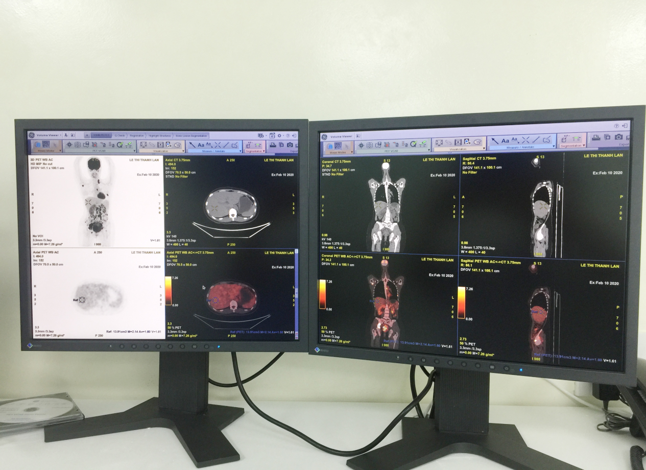 PET/CT cung cấp thông tin về cấu trúc giải phẫu và mức độ chuyển hóa của khối bướu cho bác sĩ