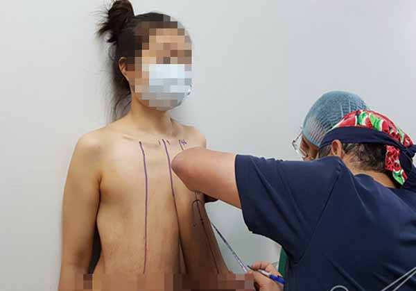 Bộ ngực dài gần nửa mét của người phụ nữ 31 tuổi trước phẫu thuật