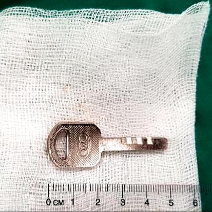 Chiếc chìa khóa được bác sĩ gắp ra khỏi bụng bệnh nhi 9 tuổi