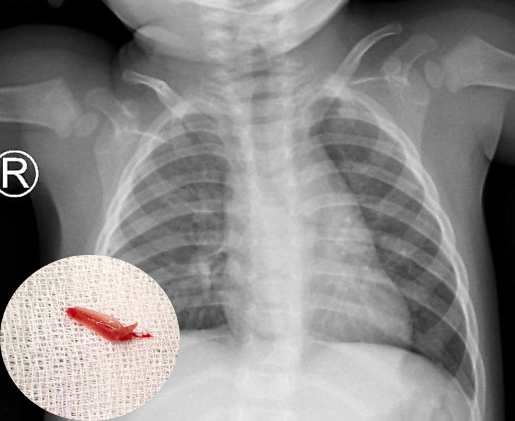 Xương cá được lấy ra khỏi phổi bé