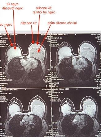 Bác sĩ chỉ định phẫu thuật lấy túi ngực hai bên. Ảnh: ThS. BS. Lê Hồng Phúc cung cấp