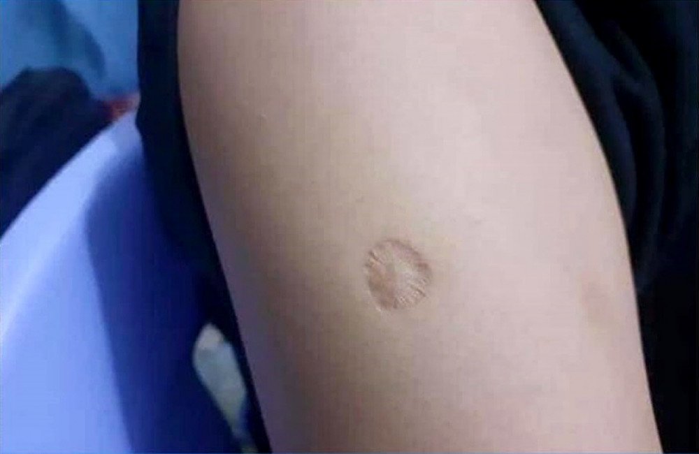 Vết sẹo do tiêm ngừa trên bắp tay nhiều người Việt Nam thế hệ 1970 - Ảnh: Internet