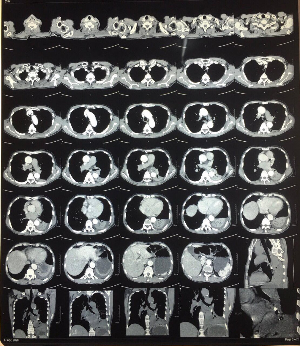 Kết quả CT Scan phổi  bệnh nhân Đ.