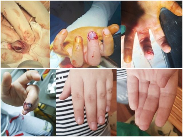 Tình trạng các ngón tay trước và sau khi được phẫu thuật xử trí.
