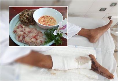 Một ngày sau khi ăn món gỏi cá rô phi, ông N.V.T. phát sốt, chân phải tê, không thể cử động. Bác sĩ chẩn đoán ông nhiễm độc tả biển”.