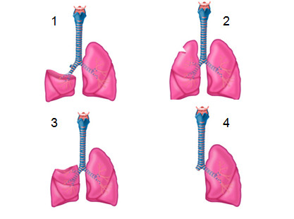 Các phẫu thuật phổi có thể là: (1)cắt thùy phổi, (2)cắt phổi hình chêm, (3)cắt phân thùy phổi và (4)cắt toàn bộ một bên phổi tùy thuộc loại bệnh và giai đoạn của bệnh