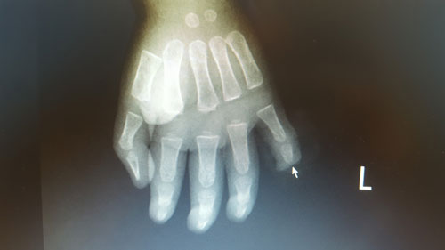 Hình ảnh phim chụp X.Quang bàn tay trái của bệnh nhi