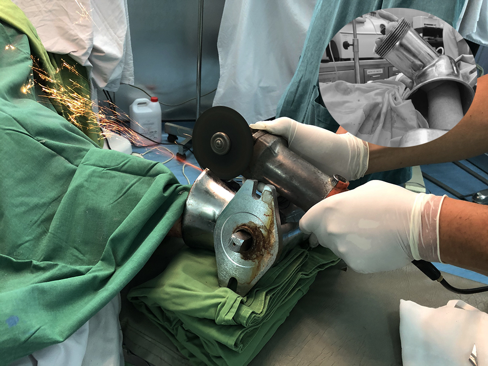 Ê-kíp bác sĩ sử dụng máy cắt để xử lý tai nạn cho chị H., ảnh BVCC