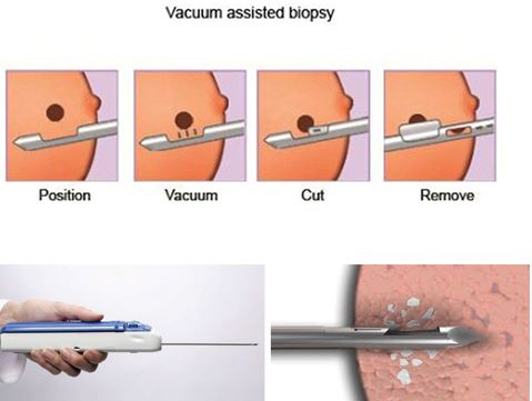 Mô phỏng quá trình sinh thiết vú bằng kỹ thuật hút chân không