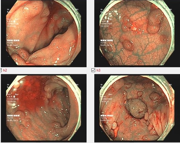 Hình ảnh nội soi đại trực tràng của bệnh nhân mắc bệnh đa polyp đại tràng