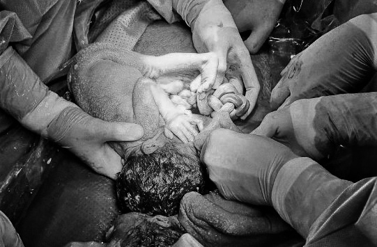 Cả ê-kíp bác sĩ kinh ngạc muốn rụng tim khi phát hiện hai bé gái sơ sinh với dây rốn vừa xoắn vừa thắt nút như lò xo, ảnh BVHV.