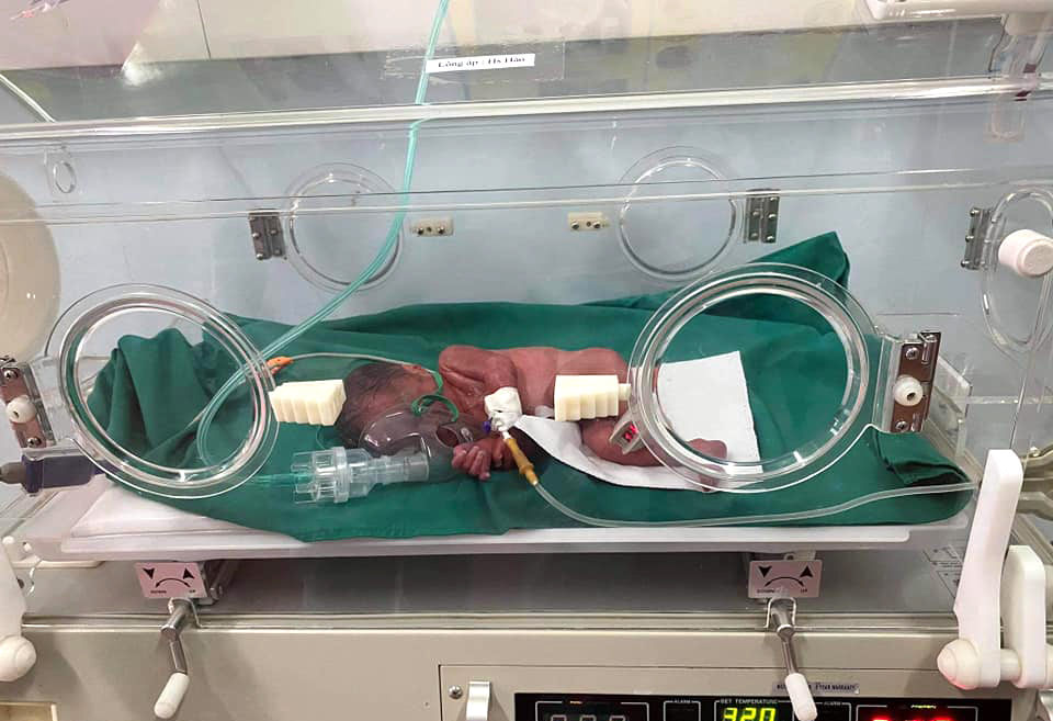 Bé trai sinh non ở tháng thứ 6 được chuyển xuống Bệnh viện Sản Nhi Nghệ An chăm sóc, theo dõi đặc biệt