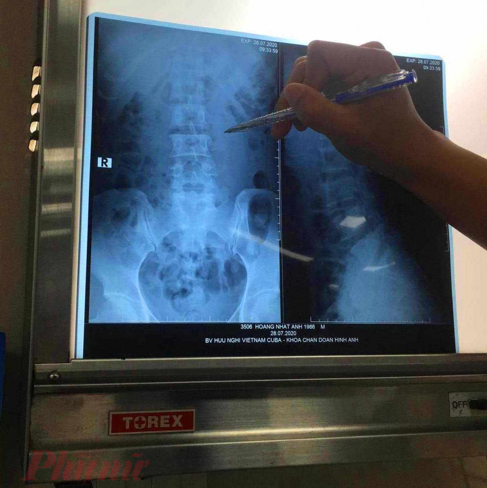 Bệnh viện Việt Nam - Cu Ba, chụp CT được chẩn đoán gãy mõm ngang L2, L3 bên trái đốt sống; khuyết eo L4, L5 cả hai bên