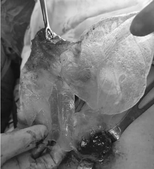 Các bác sĩ lấy phần túi ngực bị vỡ của bệnh nhân P.