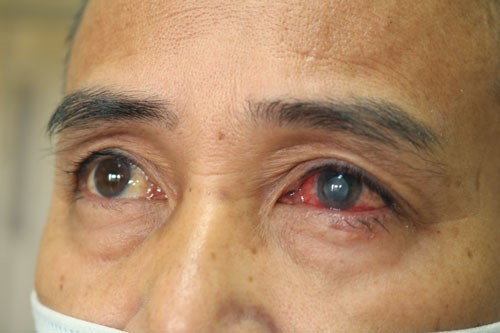 Phần mắt trái của ông N. hiện đang hồi phục sau khi điều trị