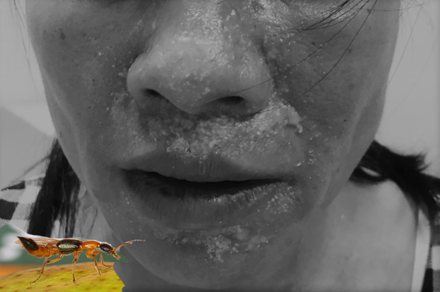 Nữ bệnh nhân nát mặt vì kiến ba khoang đốt