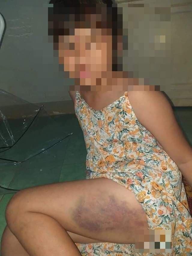Nữ sinh lớp 3 bị cô giáo đánh bầm đùi (Ảnh: MXH)