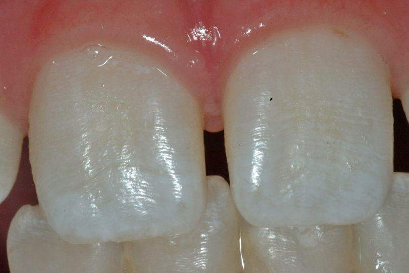 Một trường hợp răng bị “nhiễm độc F ở răng” mức nhẹ - Ảnh: ABC