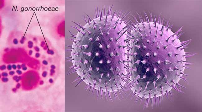 Vi khuẩn Neisseria gonorrhoeae gây bệnh lậu