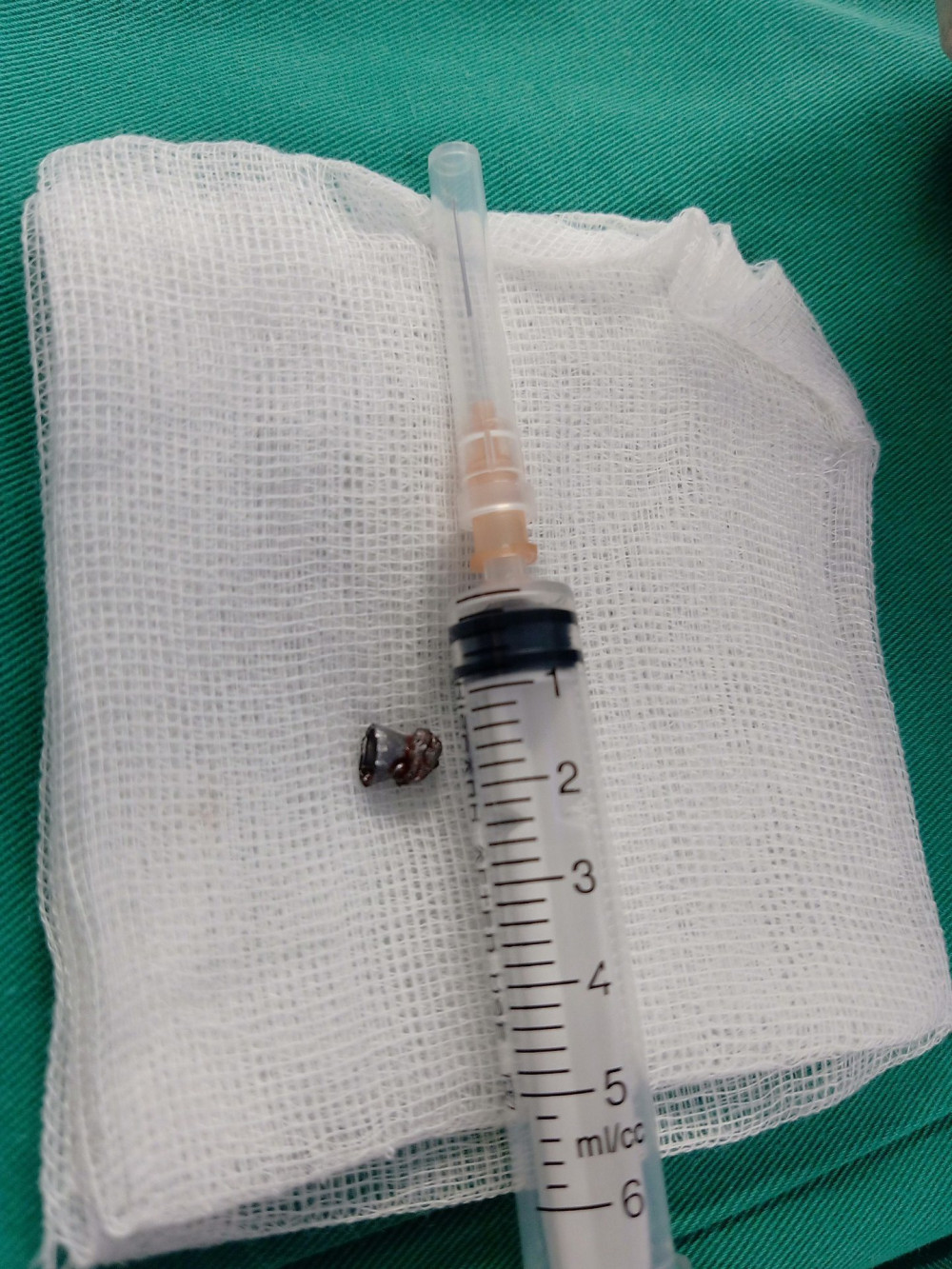 Viên đạn đã bắn xuyên từ vùng cổ lên tai của bệnh nhân