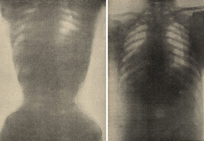 Ảnh chụp X-quang của nữ giới với áo nịt ngực (trái) và không có áo nịt ngực (phải), năm 1908.