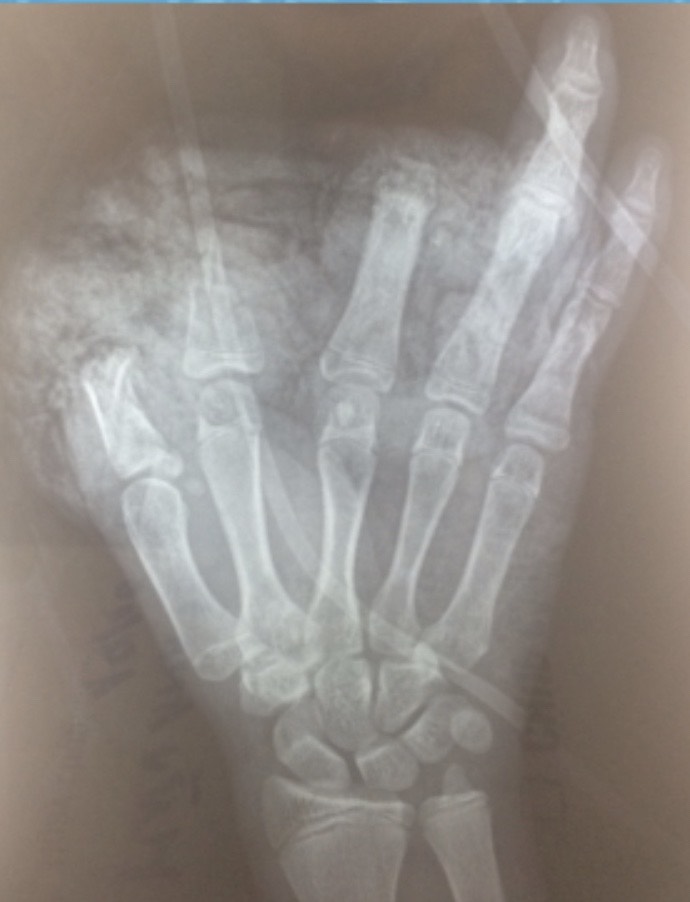 Hình ảnh chụp X-quang bàn tay bị tổn thương