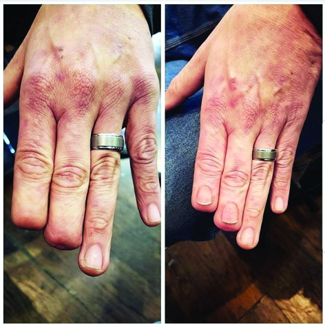 Bức ảnh Catalano đăng tải, cho thấy bàn tay với hai ngón khuyết tật của Bertram trước và sau khi tạo hình Ảnh: Kaiser Health News