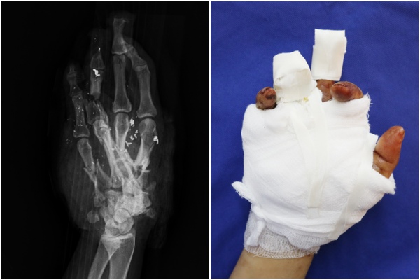 Hình ảnh chụp X-quang bàn tay phải của người bệnh và sau khi đã phẫu thuật bảo tồn các ngón tay và xương bàn cho người bệnh