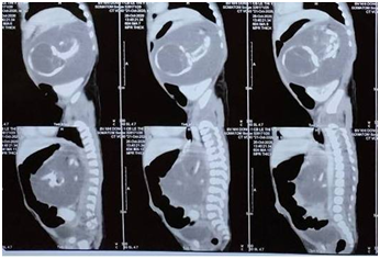Hình ảnh CT khối u to sau phúc mạc
