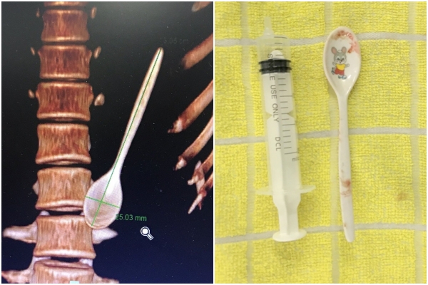 Các bác sĩ khoa Nội tiêu hóa Bệnh viện Đà Nẵng đã tiến hành thủ thuật nội soi lấy dị vật và lấy ra một muỗng nhựa dài khoảng 12 cm, rộng khoảng 2,5 cm trong dạ dày bệnh nhân. (Ảnh: Bệnh viện Đà Nẵng)