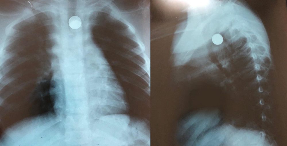 Hình ảnh chụp X-quang cho thấy viên bi sắt đang nằm ở thực quản