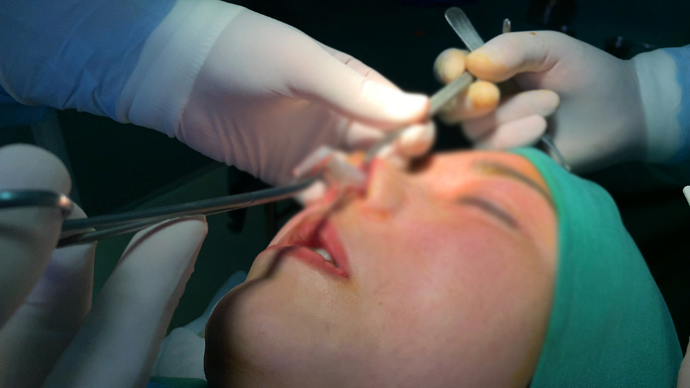 Chị N. được bác sĩ ở TPHCM phẫu thuật rút ra sụn nhân tạo để giải quyết nhiễm trùng mũi do ca nâng mũi giá hời ở Đà Lạt