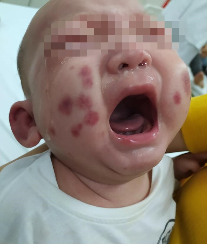 Em bé xuất hiện nhiều vết bầm trên mặt khi nhập viện