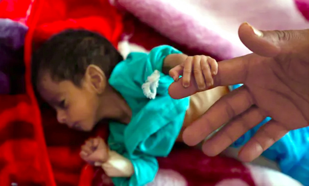Một em bé suy dinh dưỡng nắm lấy ngón tay của cha mình tại một bệnh viện ở Yemen - Ảnh: Getty Images