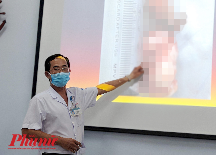 BS Nguyễn Tuấn Như với khối u dài đến 12 cm của bệnh nhi ở Tây Ninh 