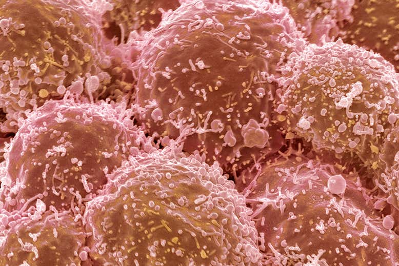 Hình ảnh tế bào ung thư phổi qua kính hiển vi