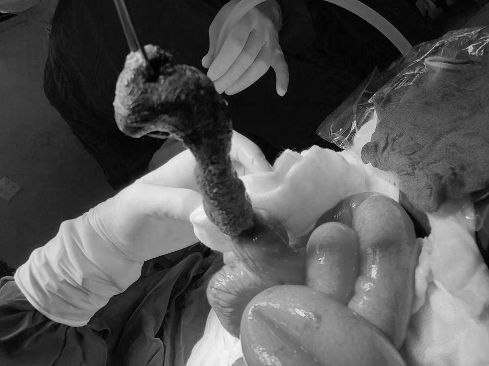 Bác sĩ phẫu thuật lấy ra búi tóc lắp gần hết ruột non của bé N., ảnh BVCC