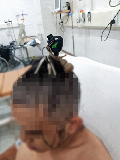 Thanh niên 20 tuổi nhập viện với chiếc chìa khóa xe máy cắm xuyên thủng hộp sọ