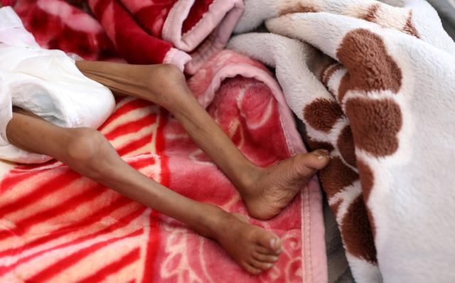 Một bé gái bị suy dinh dưỡng nằm trên giường bệnh khu điều trị suy dinh dưỡng Bệnh viện al-Sabeen ở Sanaa, Yemen, ngày 27/10/2020 - Ảnh: Reuters