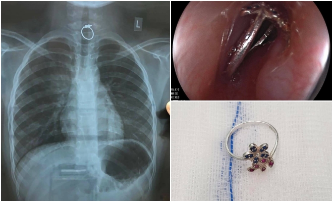 Hình ảnh chiếc nhẫn hóc trong đường thở của bệnh nhi N. Ảnh : BVCC