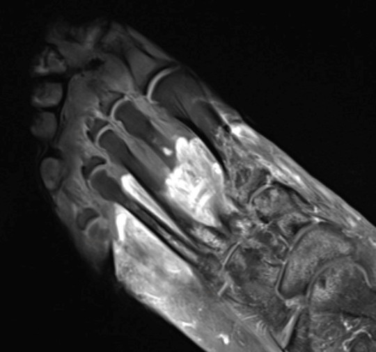 Phần màu xám nhạt của bàn chân trong ảnh chụp MRI này cho thấy mô bị tàn phế (hoại thư) xuất hiện sau khi bệnh nhân nhiễm Covid-19. Ảnh: SWNS