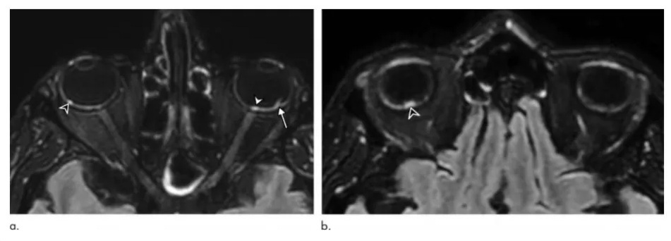 Hình ảnh quét MRI cho thấy các nốt sần (dấu mũi tên) xuất hiện phía sau mắt của bệnh nhân nhiễm COVID-19 nặng